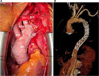 The frozen elephant trunk technique in acute aortic dissection: the ultimate solution? An institutional experience